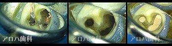 根管治療