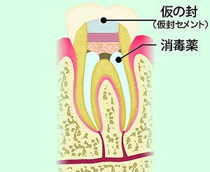 消毒薬を詰めて仮封（根管貼薬）