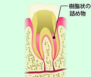 根管充填