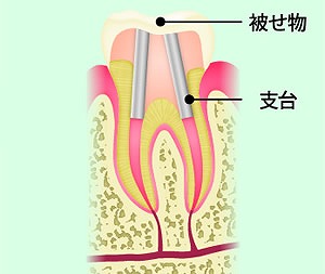 土台と被せ